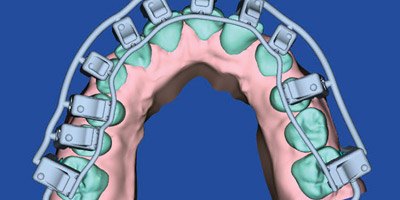 Computer orthodontic design on computer