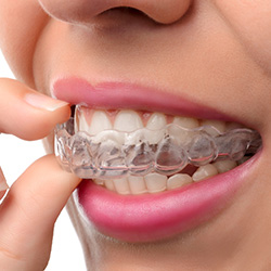 Closeup of patient placing Invisalign tray