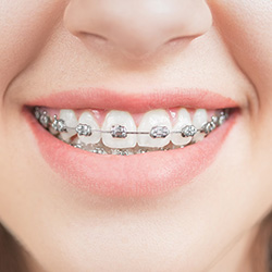 Closeup of smile with bracket and wire braces