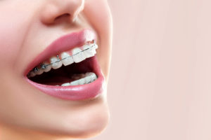 close-up of smile with braces