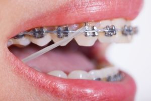 Close-up of braces